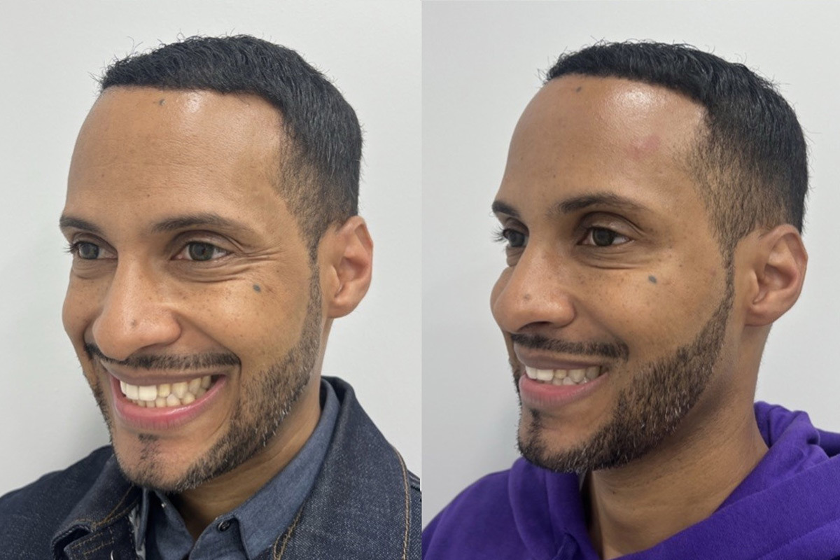 Botox Before and After Photos in Miami Beach, FL, Patient 1839
