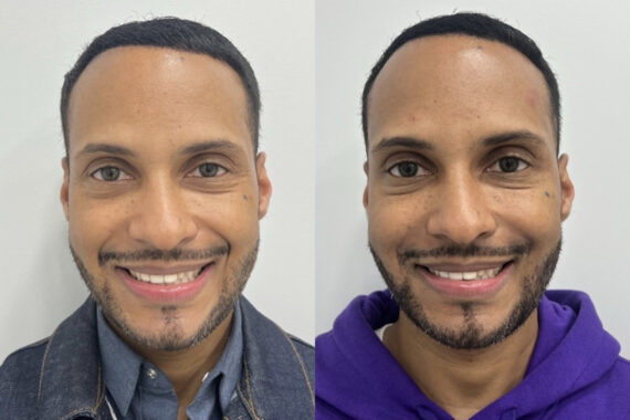 Botox Before and After Photos in Miami Beach, FL, Patient 1839