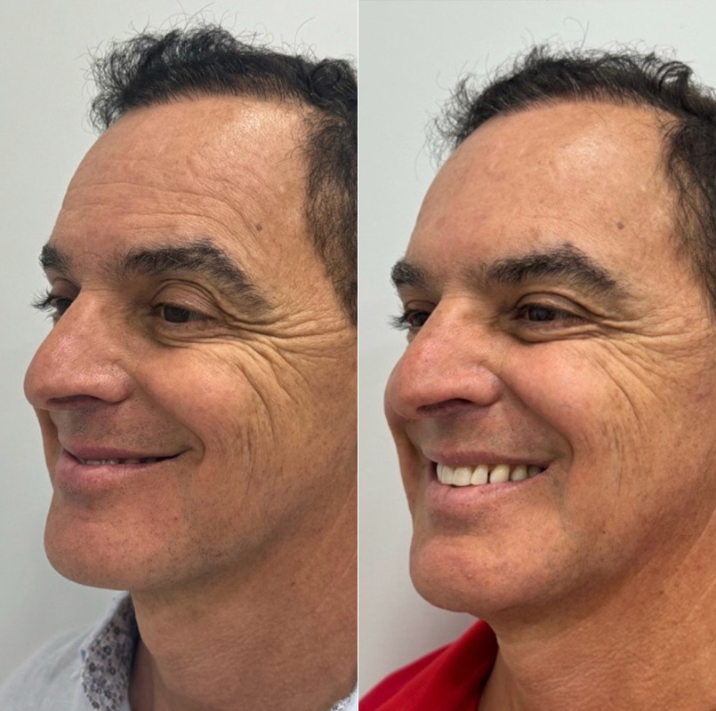 patient-1859-botox-before-after-1