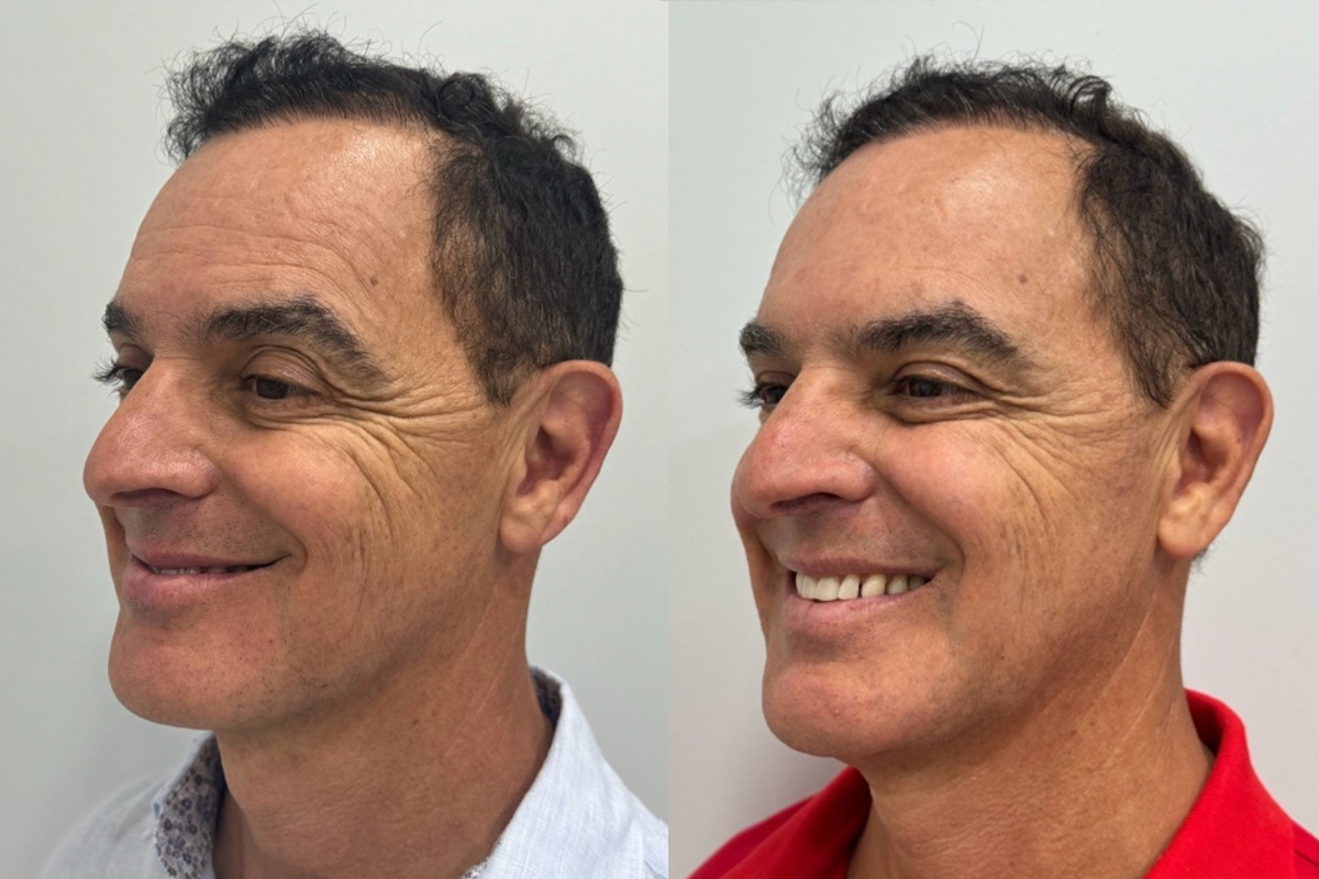Botox Before and After Photos in Miami Beach, FL, Patient 1859