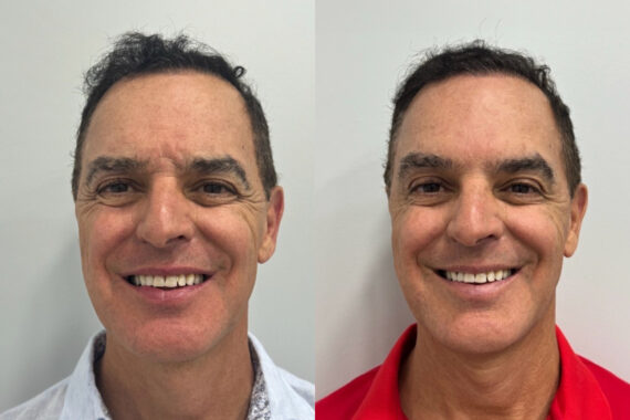 Botox Before and After Photos in Miami Beach, FL, Patient 1859