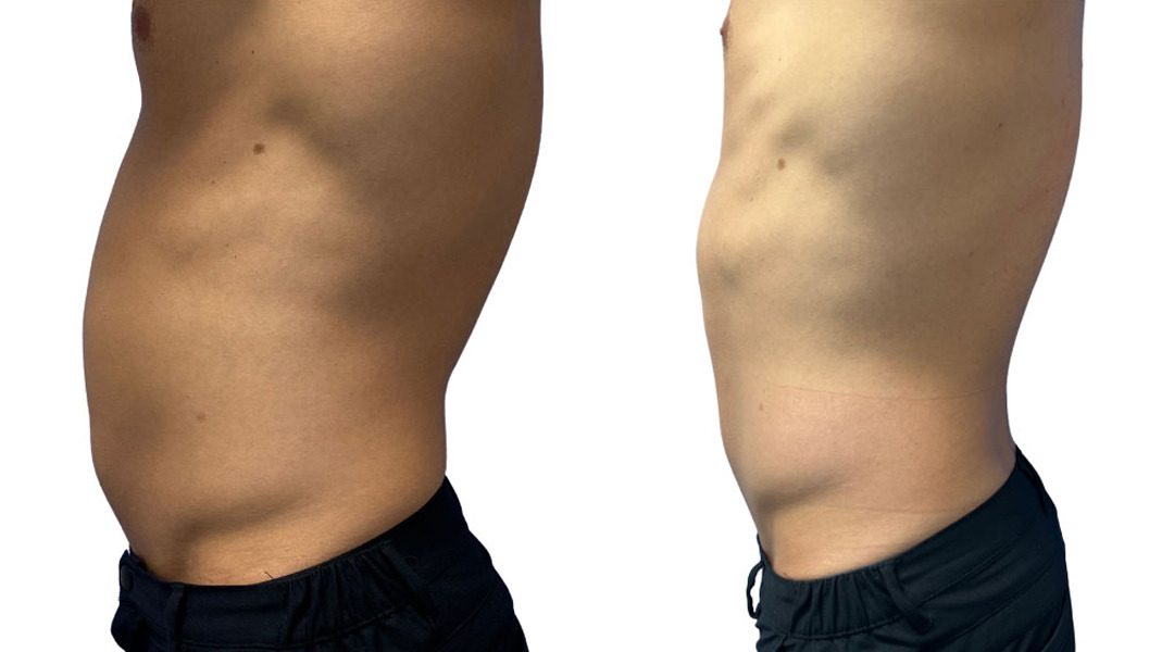 EMSculpt NEO Before and After Photos in Miami Beach, FL, Patient 2292