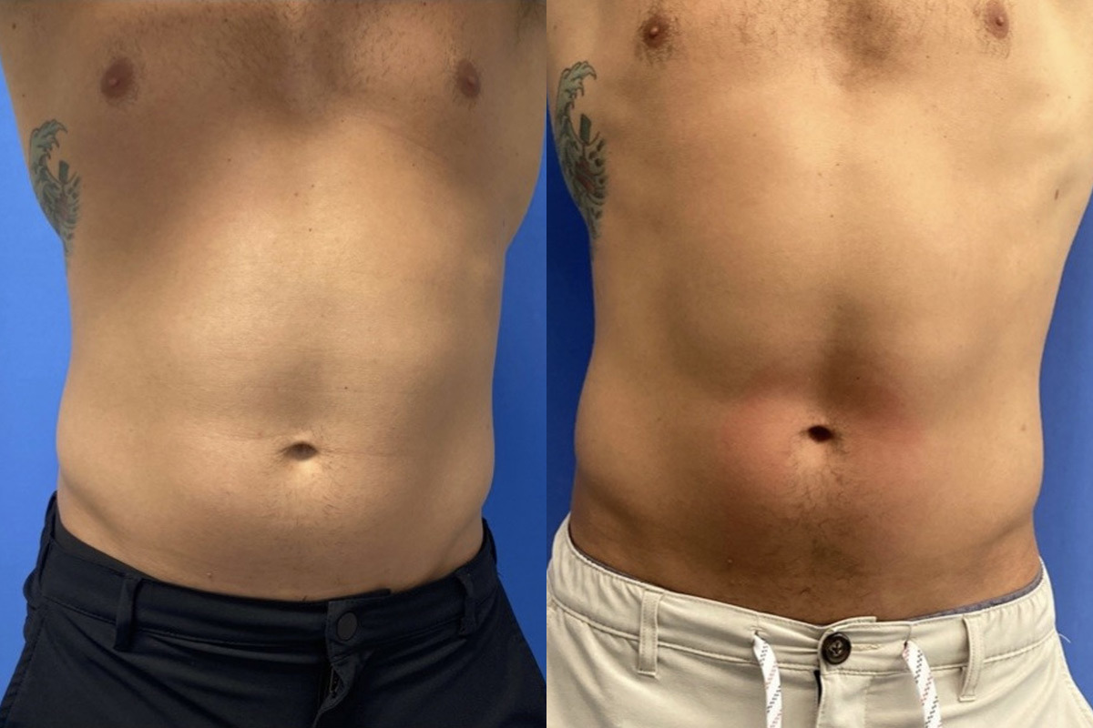 EMSculpt NEO Before and After Photos in Miami Beach, FL, Patient 2292