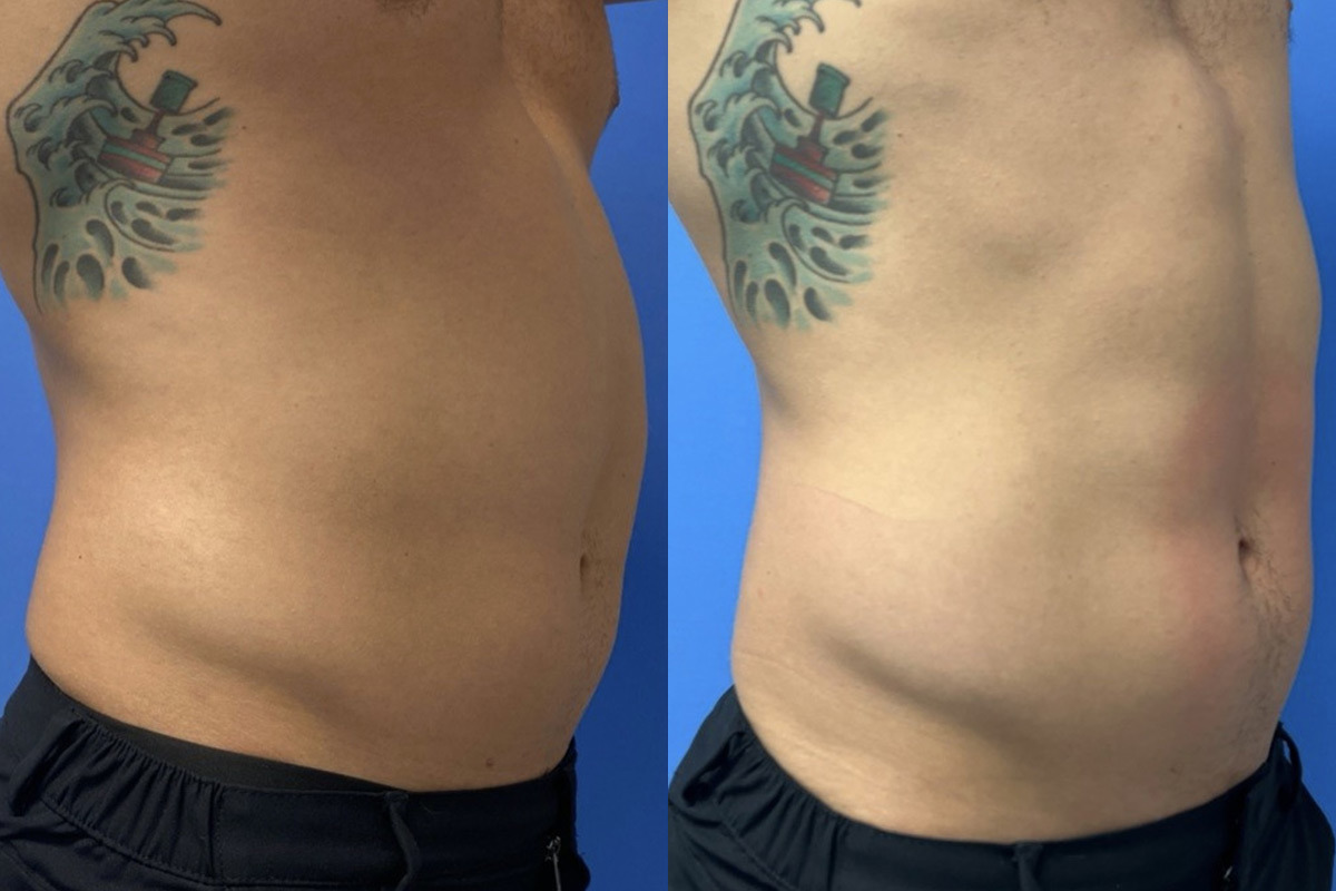 EMSculpt NEO Before and After Photos in Miami Beach, FL, Patient 2292