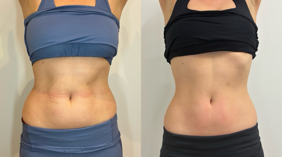 EMSculpt NEO Before and After Photos in Miami Beach, FL, Patient 2298
