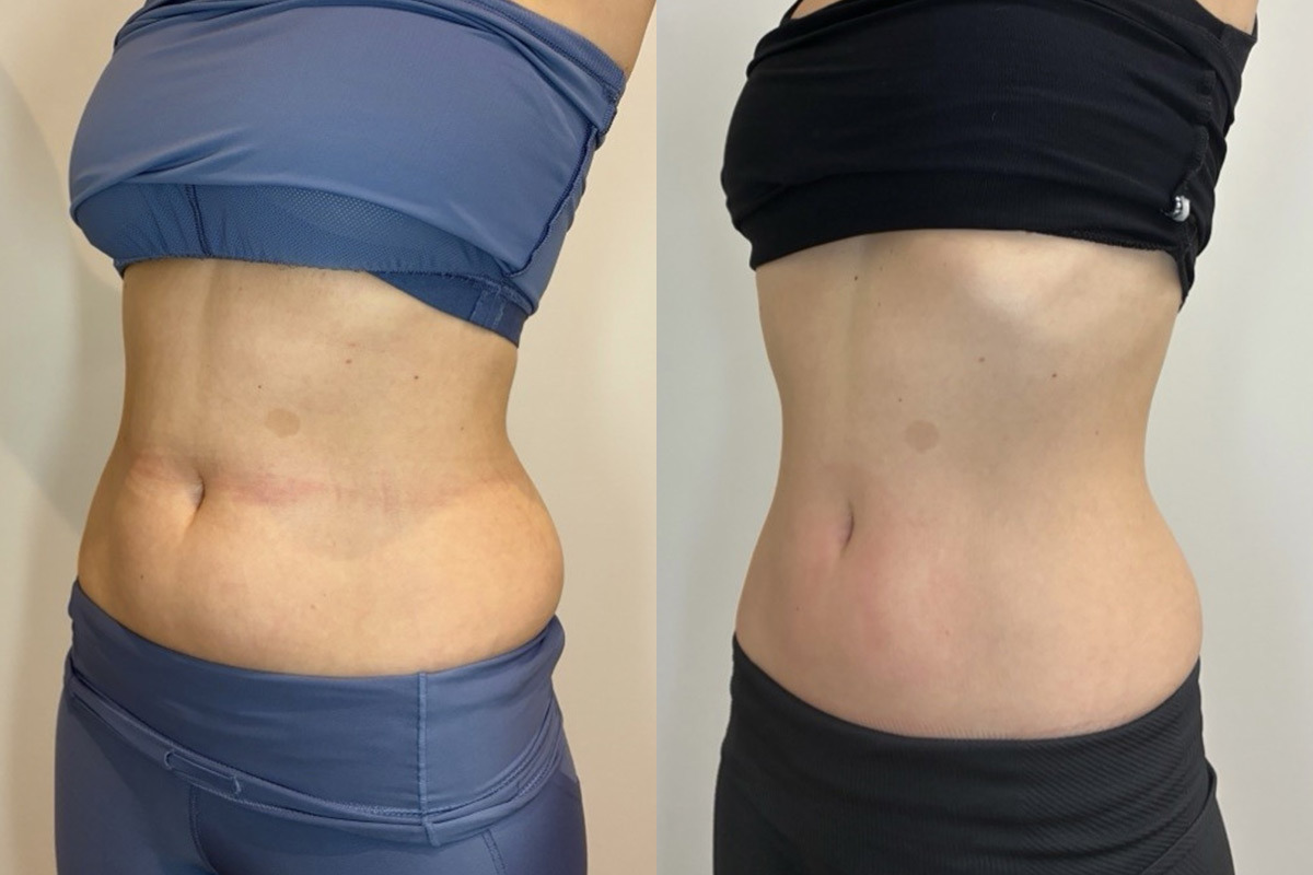 EMSculpt NEO Before and After Photos in Miami Beach, FL, Patient 2298
