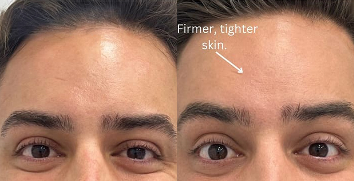 Microneedling Before and After Photos in Miami Beach, FL, Patient 2438