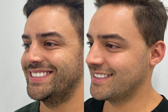 Microneedling Before and After Photos in Miami Beach, FL, Patient 2438