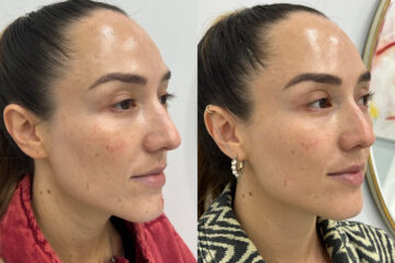 Microneedling Before and After Photos in Miami Beach, FL, Patient 2445