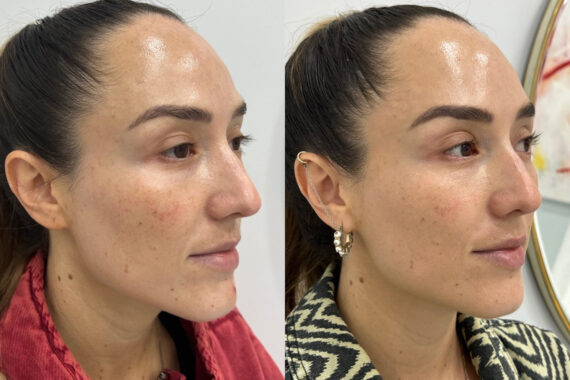 Microneedling Before and After Photos in Miami Beach, FL, Patient 2445