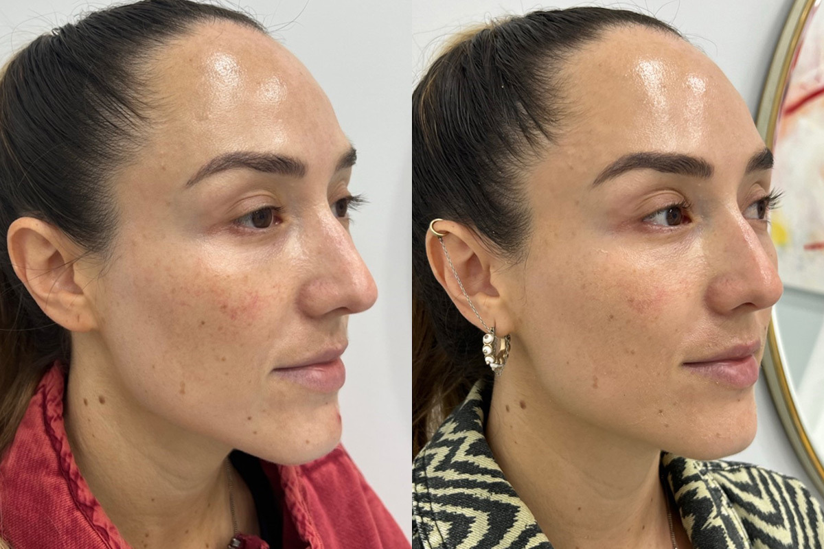Microneedling Before and After Photos in Miami Beach, FL, Patient 2445