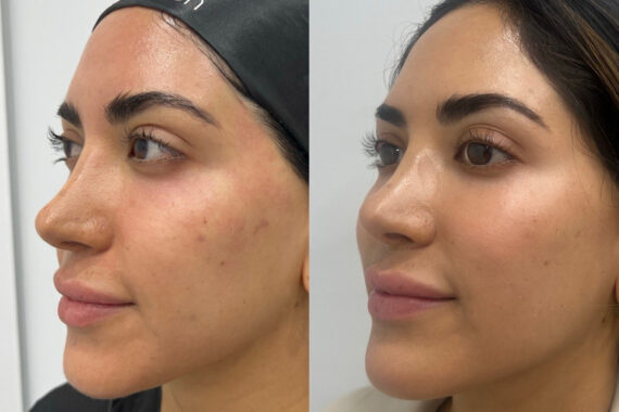 Microneedling Before and After Photos in Miami Beach, FL, Patient 2449