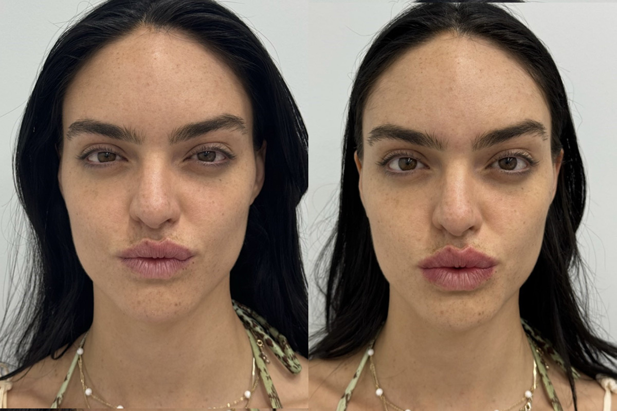 Lip Fillers Before and After Photos in Miami Beach, FL, Patient 2976
