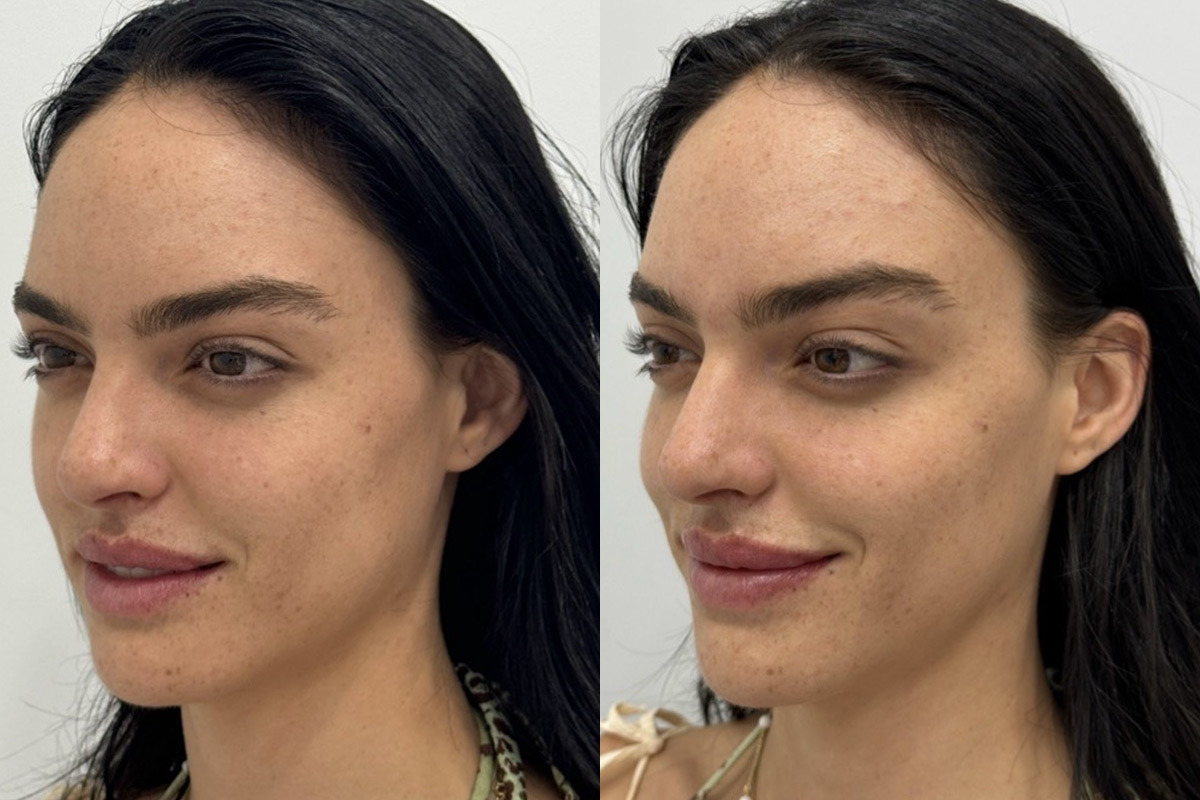 Lip Fillers Before and After Photos in Miami Beach, FL, Patient 2976