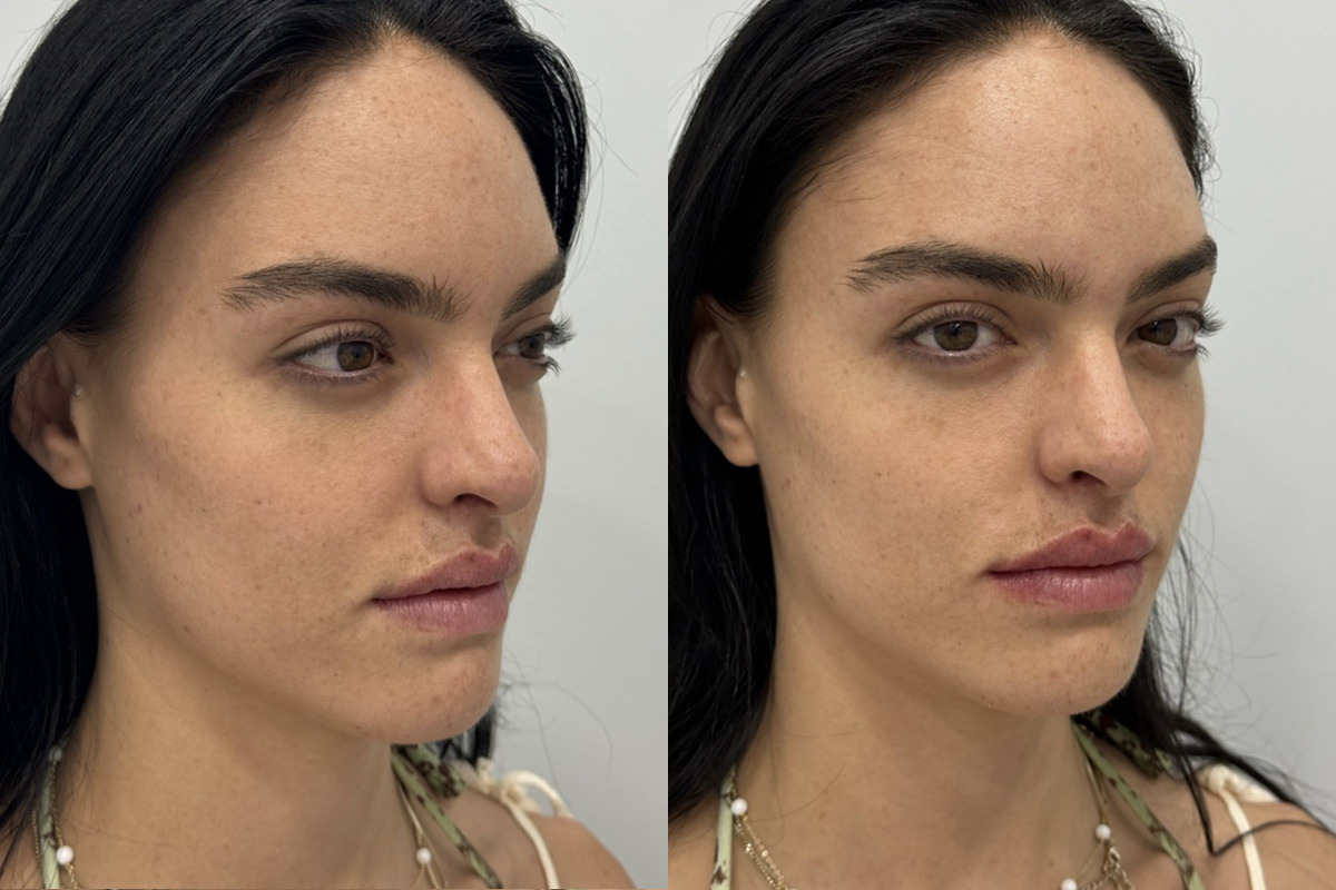 Lip Fillers Before and After Photos in Miami Beach, FL, Patient 2976
