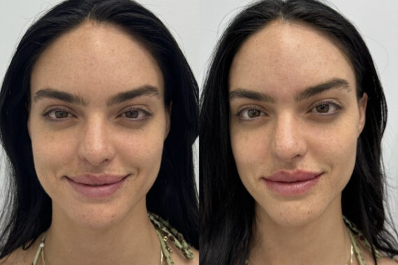 Lip Fillers Before and After Photos in Miami Beach, FL, Patient 2976
