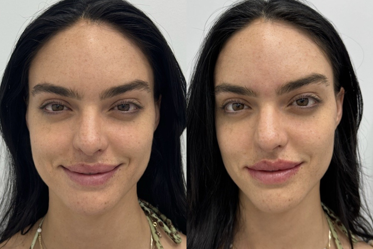 Lip Fillers Before and After Photos in Miami Beach, FL, Patient 2976