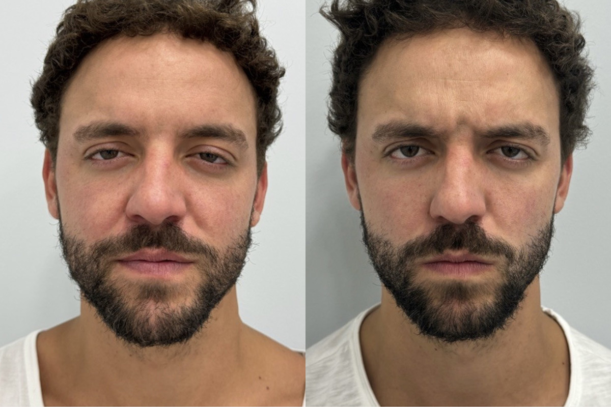 Botox Before and After Photos in Miami Beach, FL, Patient 9422