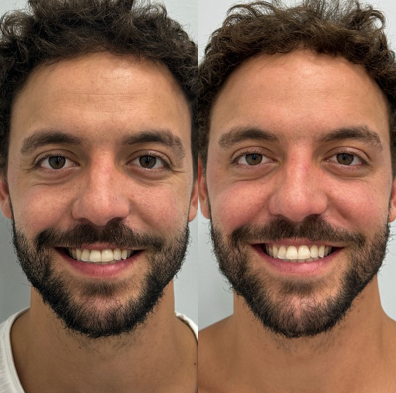 patient-9422-botox-before-after