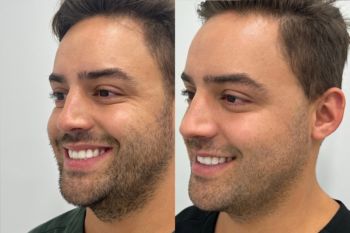 Botox Before and After Photos in Miami Beach, FL, Patient 9435