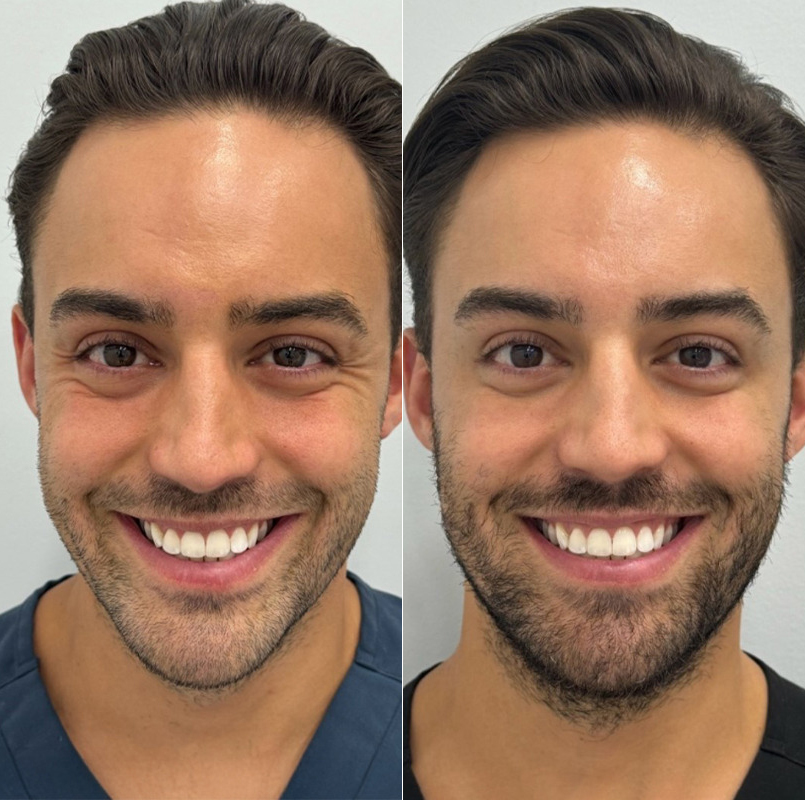 patient-9435-botox-before-after