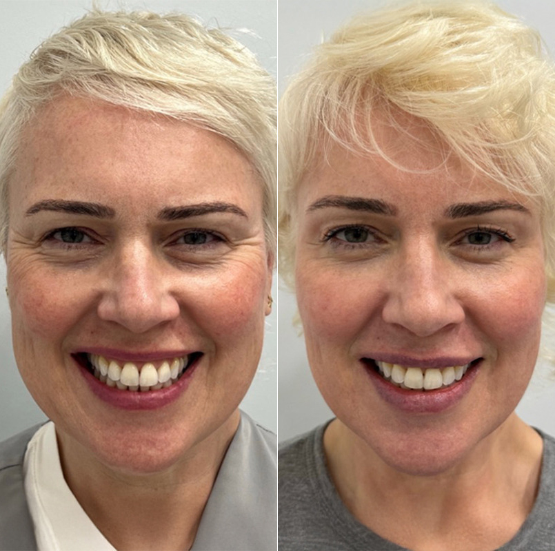 patient-9457-botox-before-after