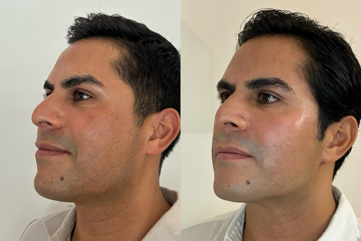 Bio Re-Peel Before and After Photos in Miami Beach, FL, Patient 12398