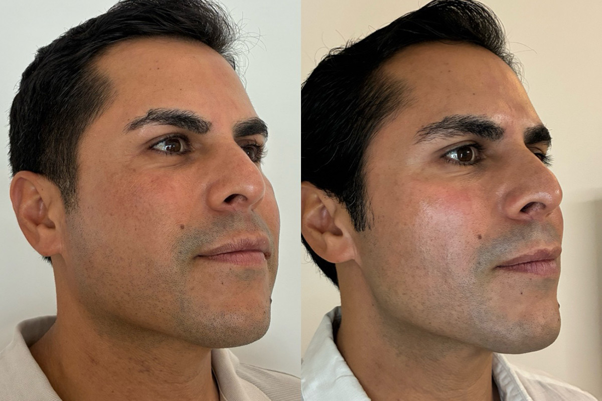 Bio Re-Peel Before and After Photos in Miami Beach, FL, Patient 12398