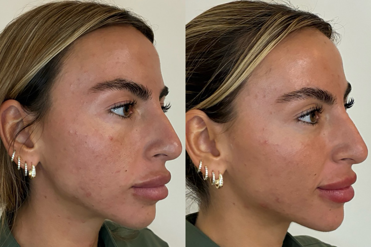 Bio Re-Peel Before and After Photos in Miami Beach, FL, Patient 12411
