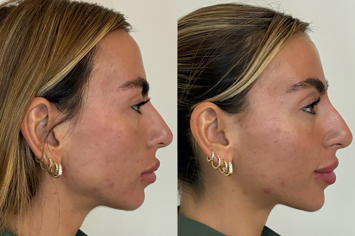 Bio Re-Peel Before and After Photos in Miami Beach, FL, Patient 12411