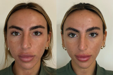 Bio Re-Peel Before and After Photos in Miami Beach, FL, Patient 12411