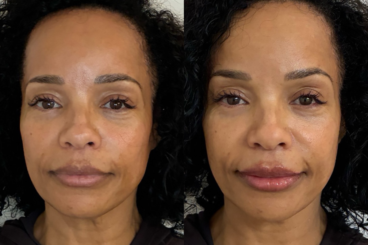 Botox Before and After Photos in Miami Beach, FL, Patient 12594