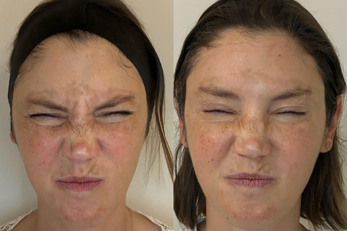 Botox Before and After Photos in Miami Beach, FL, Patient 12606
