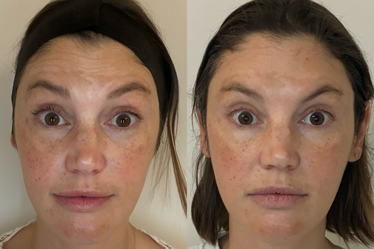 Botox Before and After Photos in Miami Beach, FL, Patient 12606