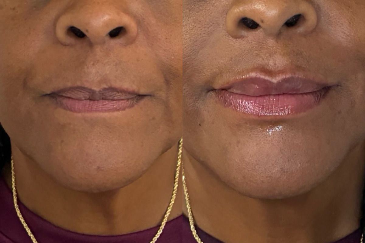 Botox Before and After Photos in Miami Beach, FL, Patient 12610