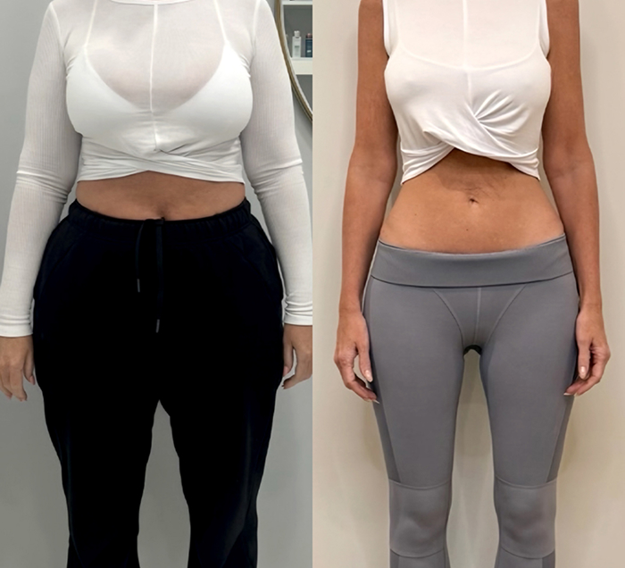 Before and after comparison of a woman’s body showing visible weight loss results from oral Wegovy treatment.