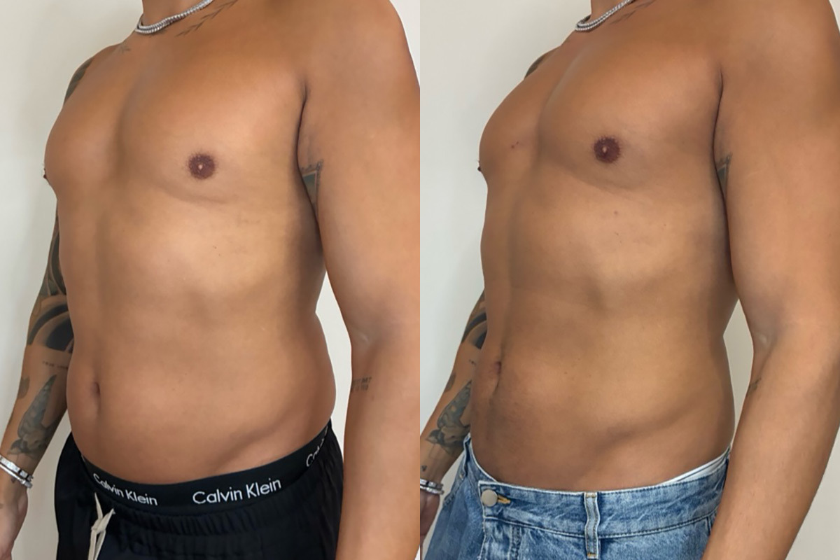 EMSculpt NEO Before and After Photos in Miami Beach, FL, Patient 13236