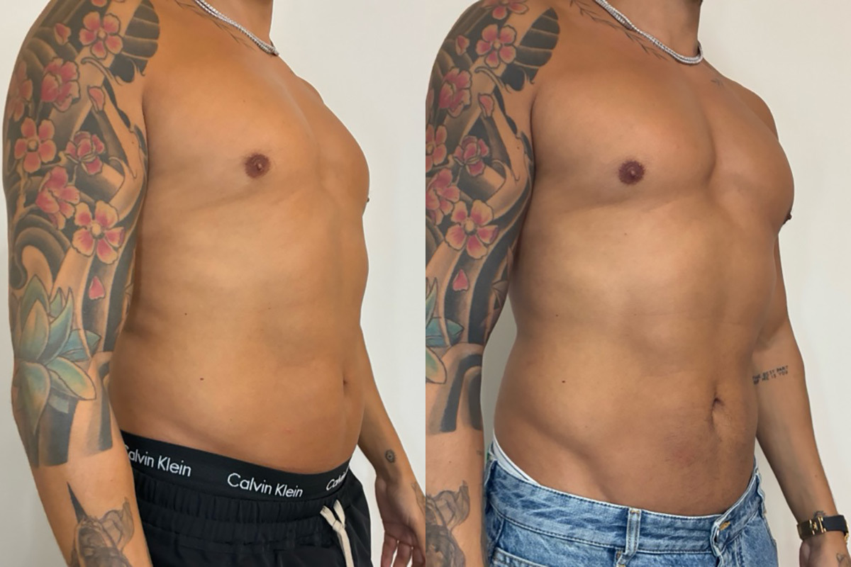 EMSculpt NEO Before and After Photos in Miami Beach, FL, Patient 13236