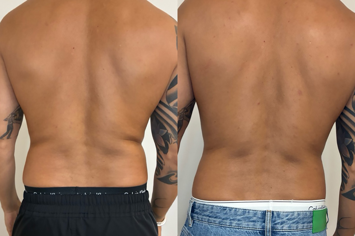 EMSculpt NEO Before and After Photos in Miami Beach, FL, Patient 13236