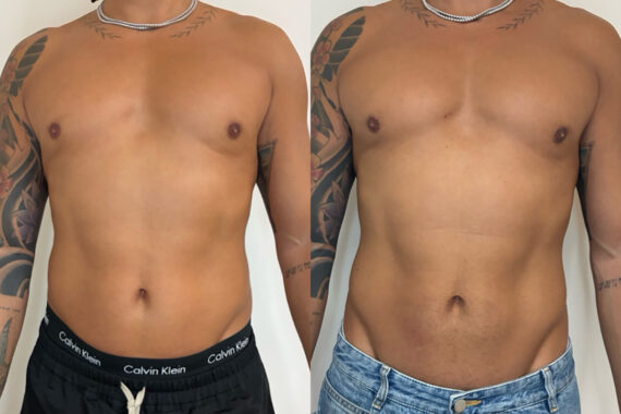 EMSculpt NEO Before and After Photos in Miami Beach, FL, Patient 13236