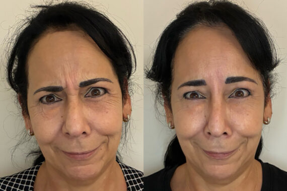 Botox Before and After Photos in Miami Beach, FL, Patient 13254