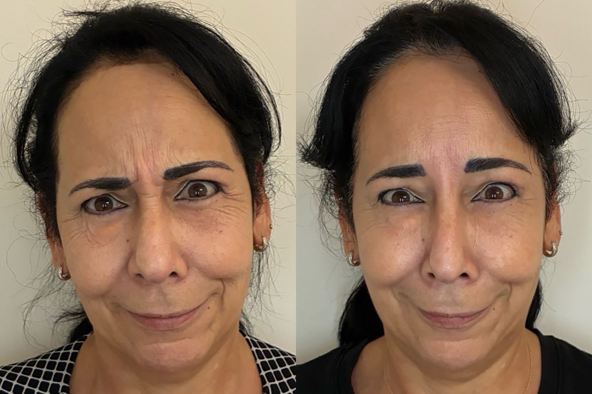 Botox Before and After Photos in Miami Beach, FL, Patient 13254