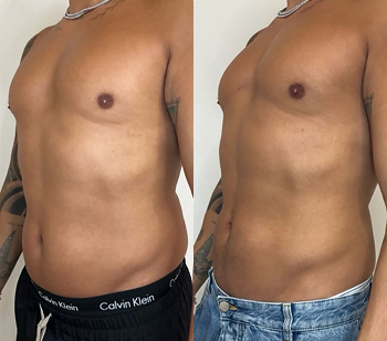 emsculpt before and after