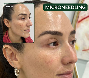 MIcroneedling BA
