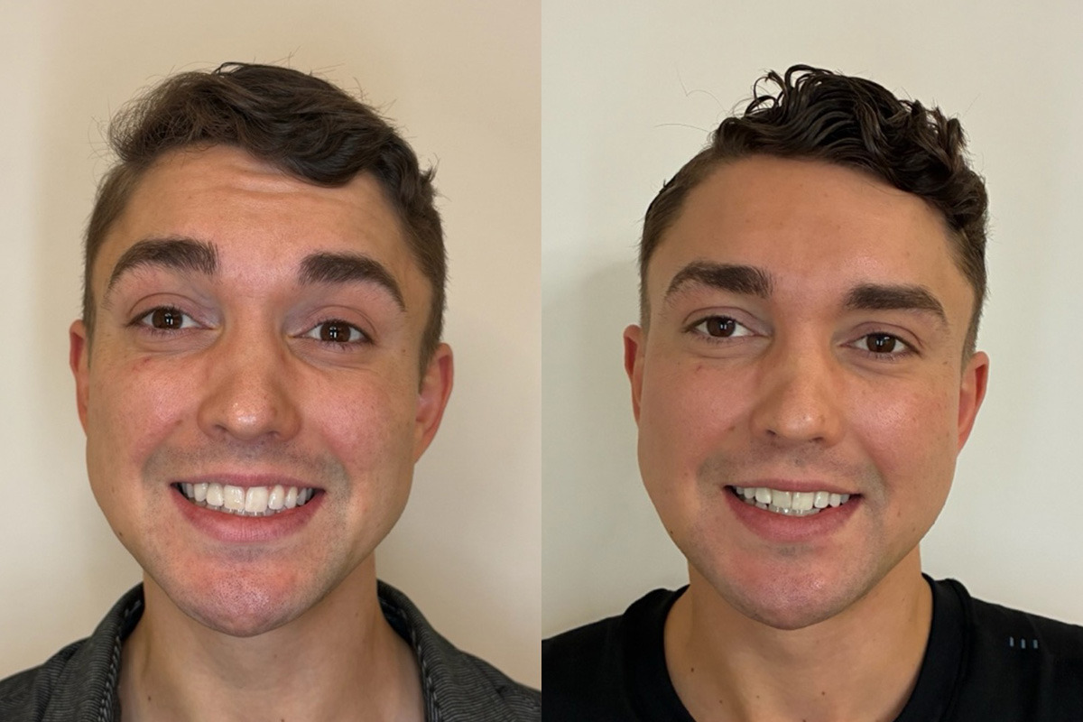 Botox Before and After Photos in Miami Beach, FL, Patient 14413