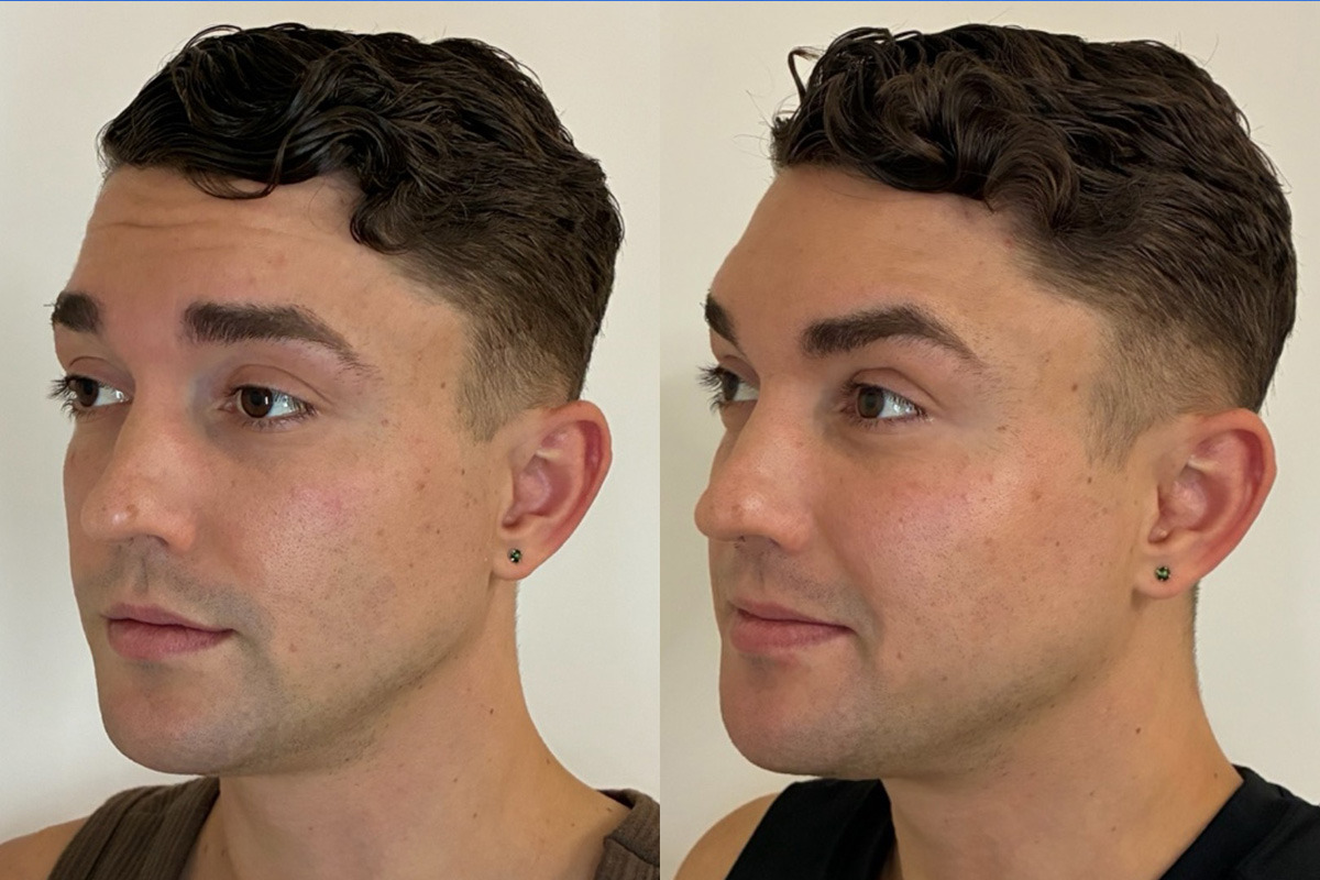Botox Before and After Photos in Miami Beach, FL, Patient 14413