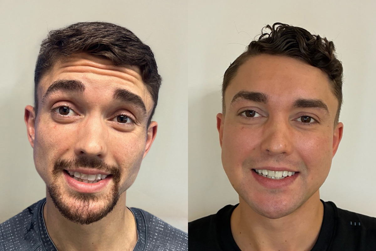 Botox Before and After Photos in Miami Beach, FL, Patient 14413