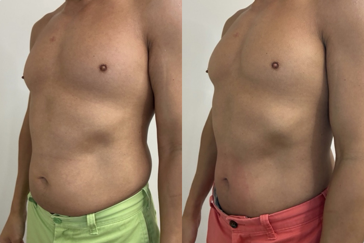EMSculpt NEO Before and After Photos in Miami Beach, FL, Patient 14434