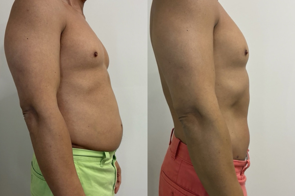 EMSculpt NEO Before and After Photos in Miami Beach, FL, Patient 14434