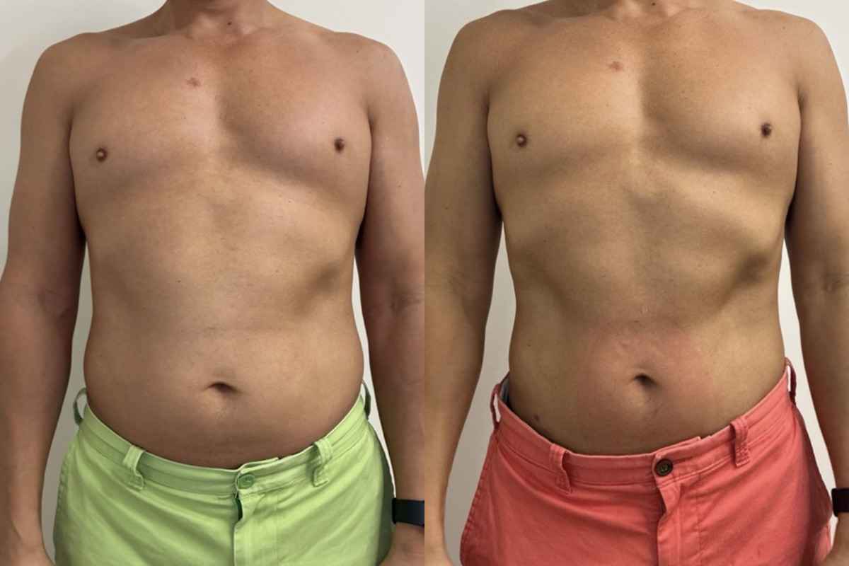 EMSculpt NEO Before and After Photos in Miami Beach, FL, Patient 14434